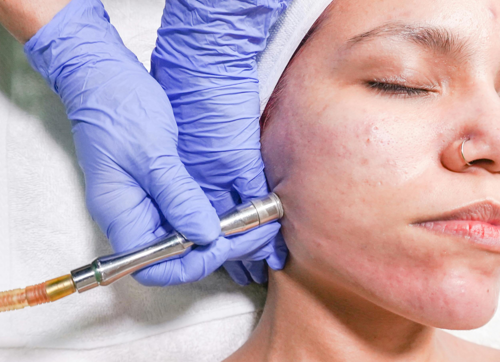 Microdermabrasion treatment at IUVENTUS MEDICAL CENTER Las Vegas