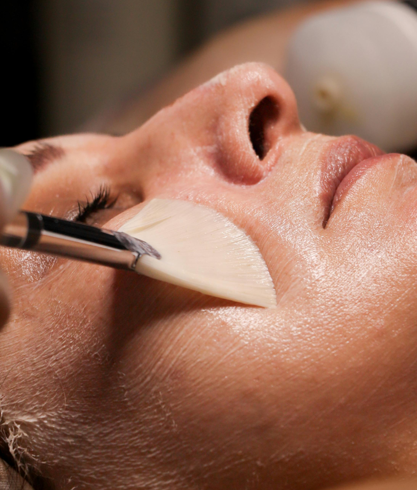 Chemical peel treatment at IUVENTUS MEDICAL CENTER Las Vegas